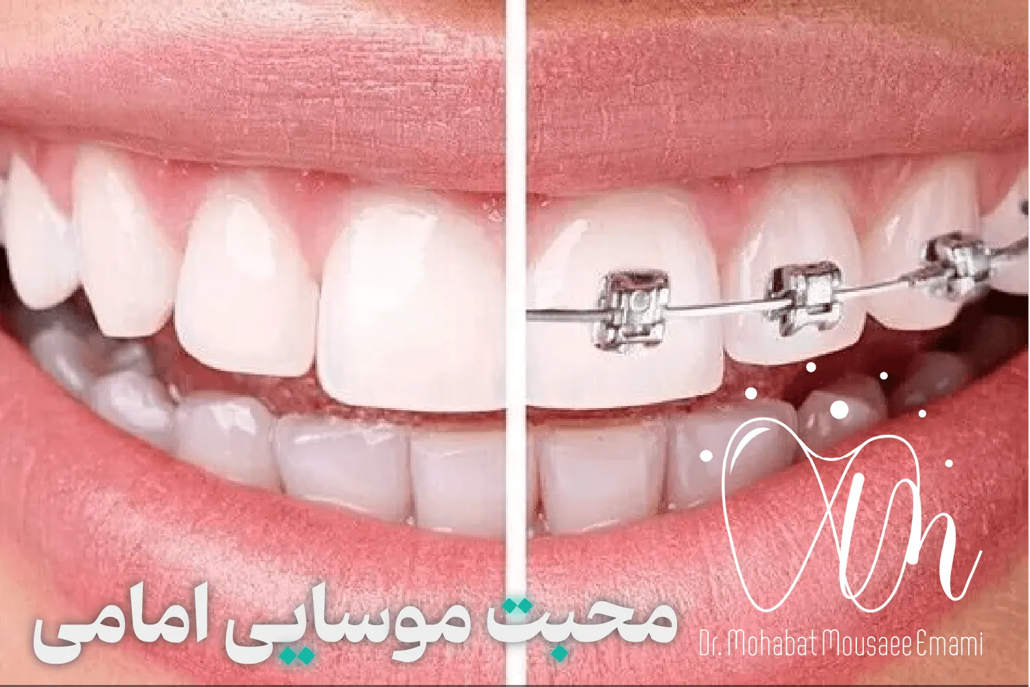 قبل و بعد ارتودنسی | درمان 1